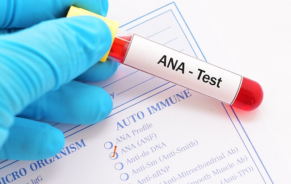 Xét nghiệm kháng thể kháng nhân (ANA) thường là xét nghiệm đầu tiên