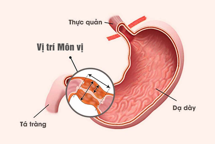 Hẹp môn vị.