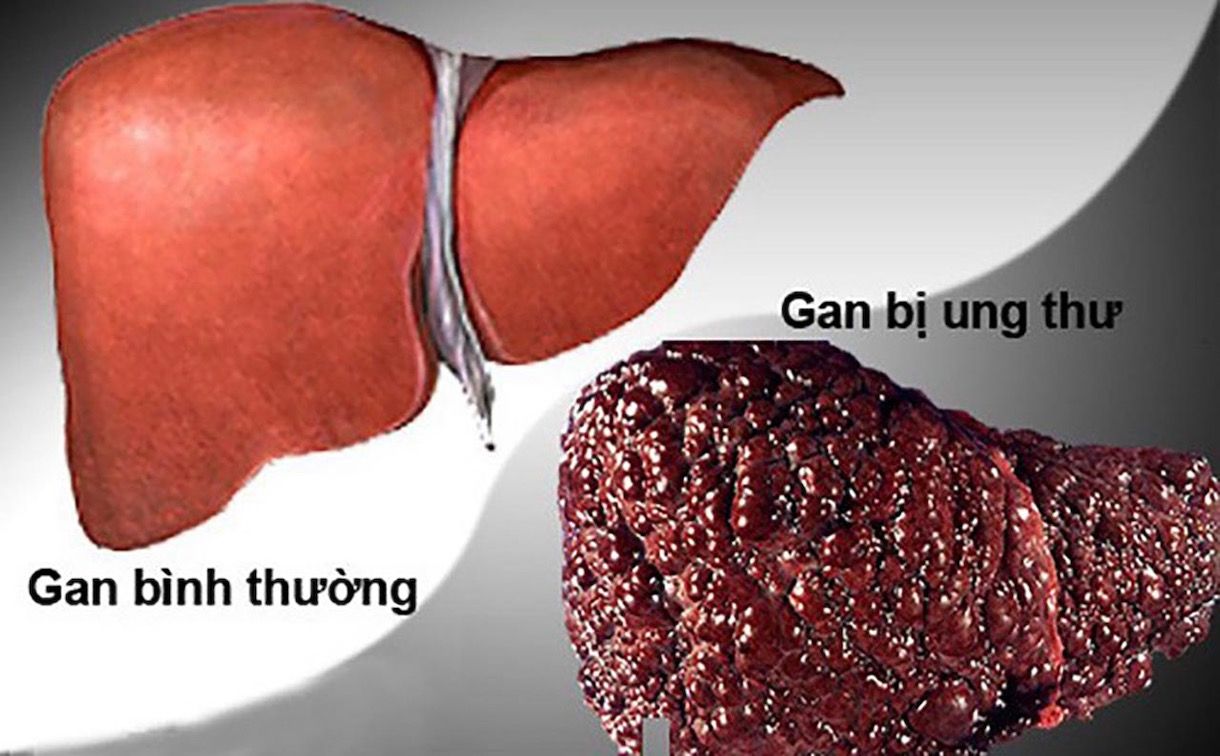 HÌNH ẢNH UNG THƯ GAN THỨ PHÁT VỚI CÁC TỔN THƯƠNG DI CĂN ĐA Ổ TRONG GAN