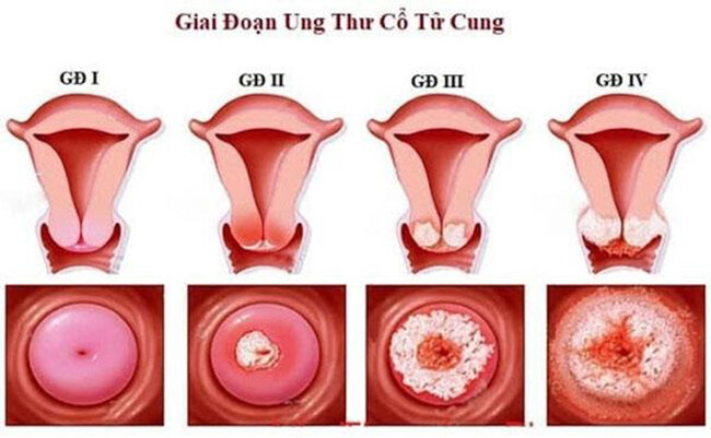 Các giai đoạn phát triển của ung thư tử cung