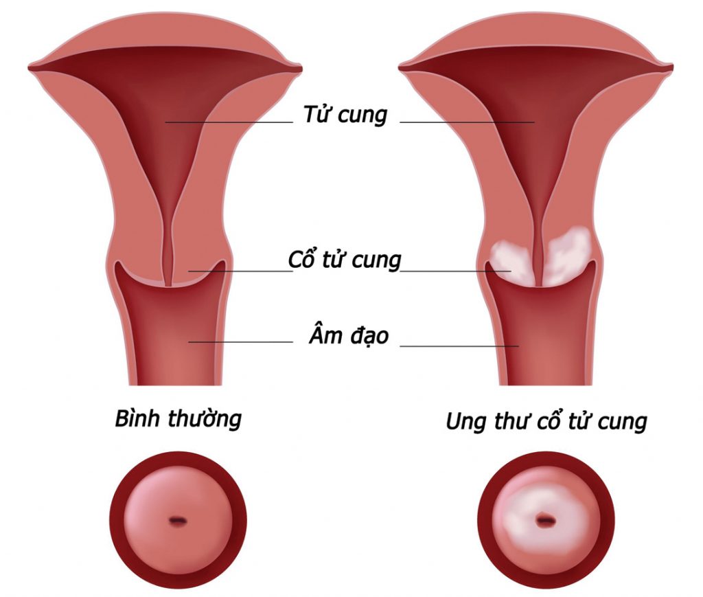 Bệnh Ung Thư Tử Cung Có Chữa Được Không?