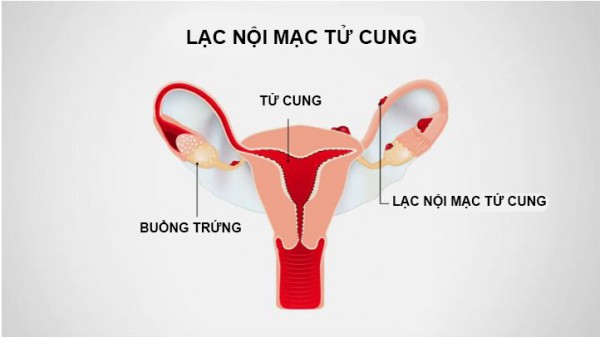 Lạc nội mạc tử cung