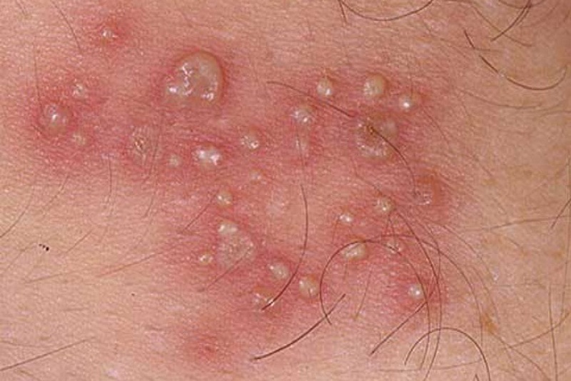 Biến chứng bệnh herpes sinh dục