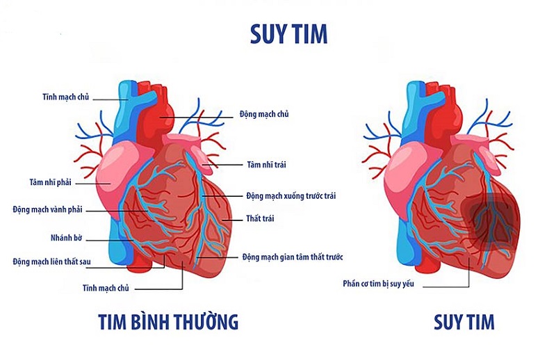 Suy tim là biến chứng thường gặp ở người bị nhồi máu cơ tim cấp