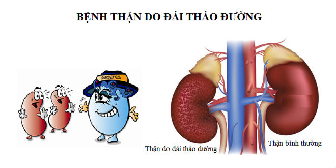 Bệnh thận do đái tháo đường 