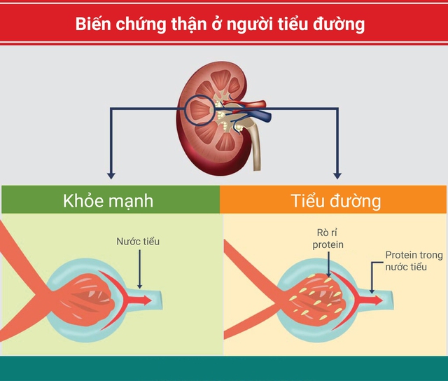 Các biểu hiện tổn thương thận ở bệnh đái tháo đường thường âm thầm