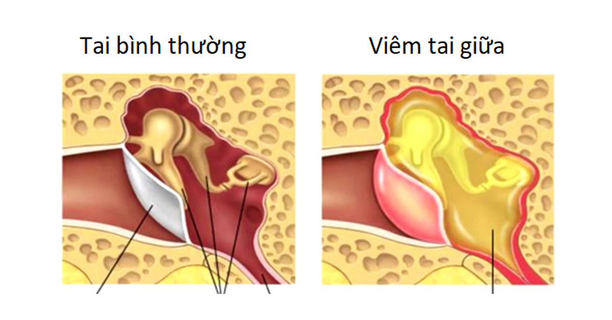 Viêm tai giữa là tình trạng tai giữa bị nhiễm trùng