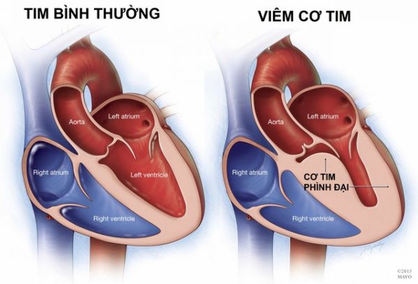 Viêm cơ tim là một trong những biến chứng nguy hiểm của bệnh bạch hầu