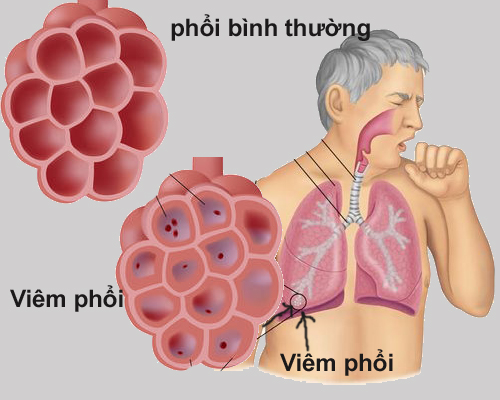 Vi khuẩn gây bệnh bạch hầu có thể lan xuống phổi, gây viêm phổi