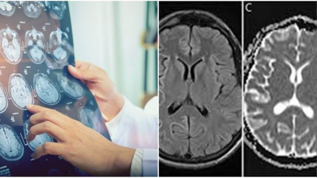 Chụp MRI có thể chẩn đoán được tình trạng não