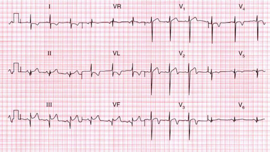 Tiến hành đo điện tâm đồ để chẩn đoán HC Brugada .