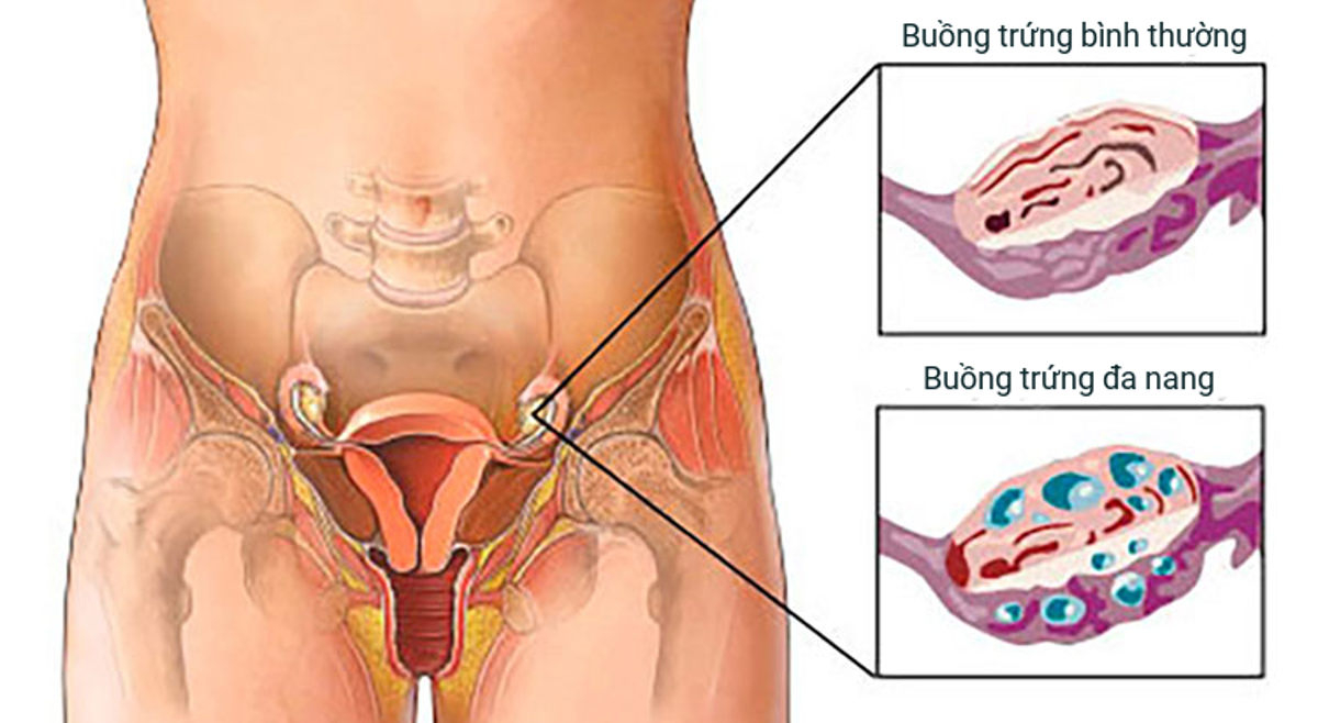 hiểu rõ về buồng trứng đa nang