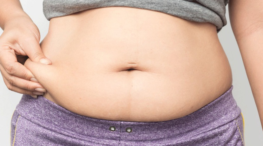 Khoảng 80-90% phụ nữ mắc buồng trứng đa nang bị béo phì