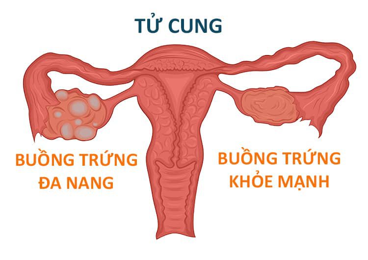 Buồng trứng đa nang 