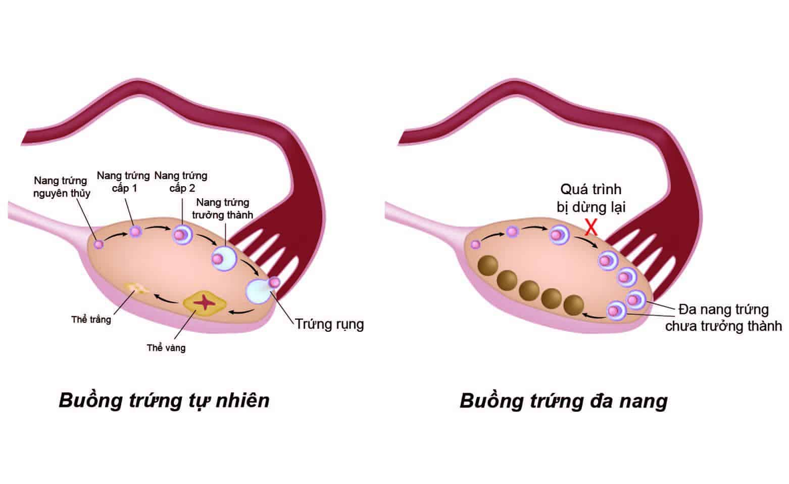 Buồng trứng đa nang (PCOS)