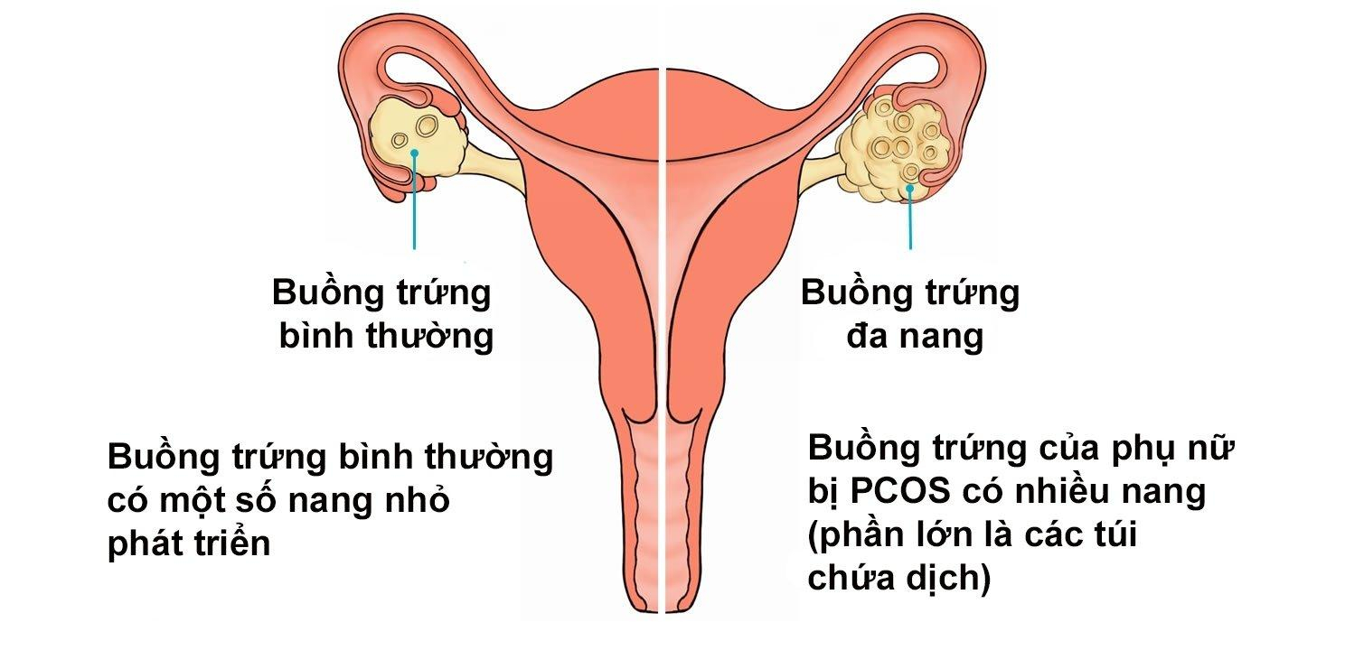 Buồng trứng đa nang (PCOS)