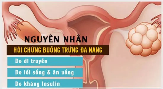 Nguyên nhân hội chứng buồng trứng đa nang