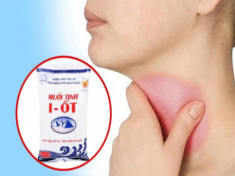 Thiếu hụt i-ốt là nguyên nhân chính gây nên bệnh bướu cổ
