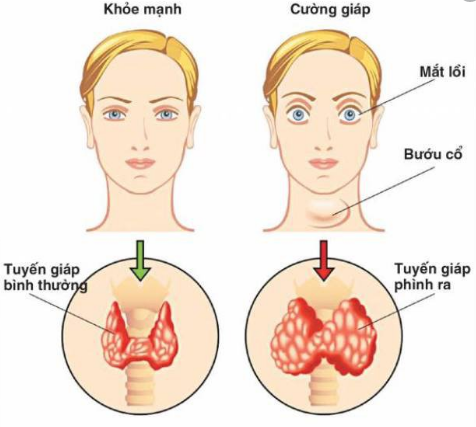 Bệnh Basedow gây ra hiện tượng lồi mắt ở người