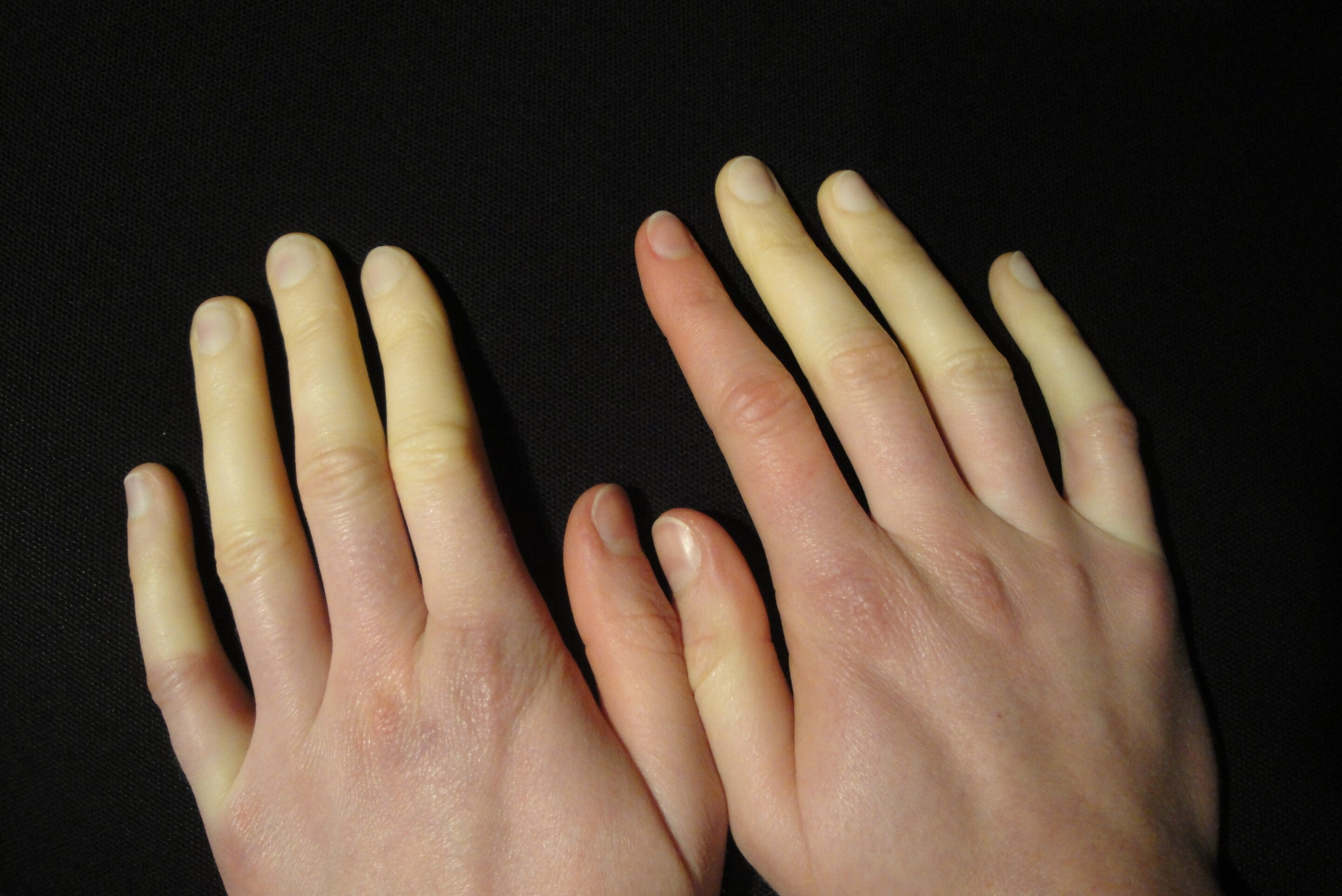 Hội chứng Raynaud làm thay đổi màu sắc và cảm giác ở các ngón tay