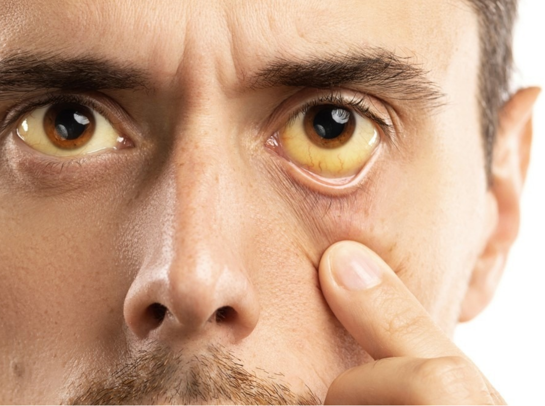 Viêm gan A có đang tăng trở lại? Vì sao nhiều ca phát hiện muộn và giải pháp test viêm gan tại nhà 2 Viêm gan là gì? Những điều cần biết về viêm gan