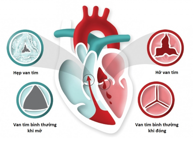 Minh hoạ về các hoạt động của van tim
