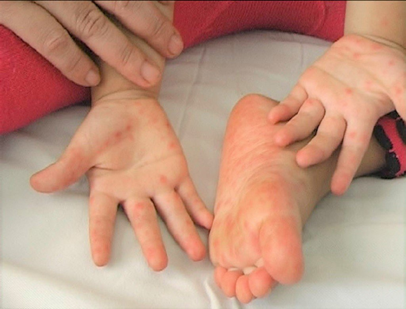 Bệnh tay chân miệng: tìm hiểu căn bệnh và cách phòng ngừa