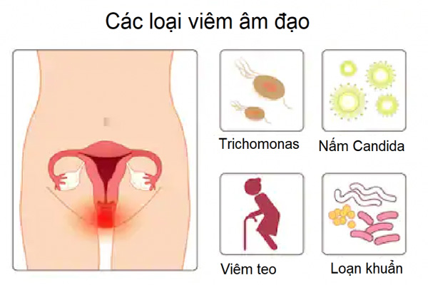 4 loại viêm âm đạo