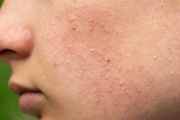 Mách bạn cách trị mụn đầu trắng hiệu quả tại nhà