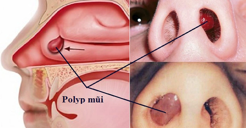 Ngứa mũi do bệnh Polyp mũi