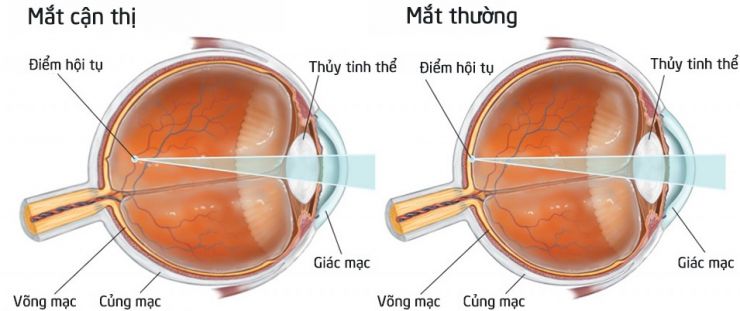 Cận thị gây những ảnh hưởng nào?