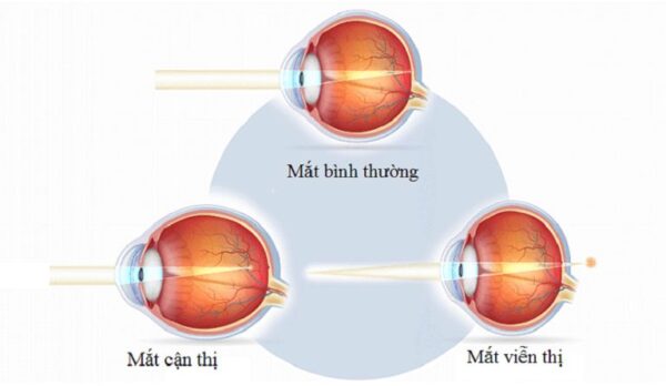 So sánh giữa mắt thường với mắt bị cận thị, viễn thị