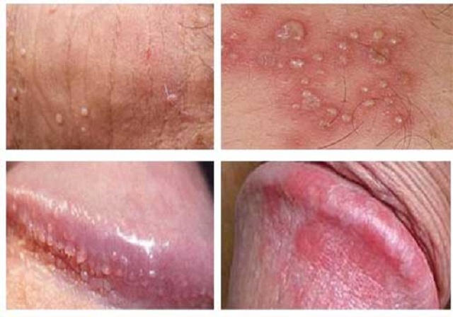 NGỨA BỘ PHẬN SINH DỤC NAM BÔI THUỐC GÌ CẦN DỰA TRÊN CHẨN ĐOÁN NGUYÊN NHÂN CỤ THỂ