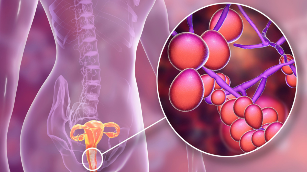 Viêm nhiễm âm đạo do nấm Candida cần được điều trị sớm