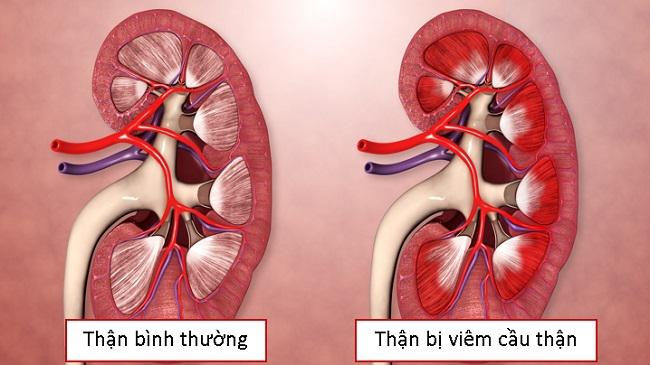 4. Chẩn đoán viêm cầu thận