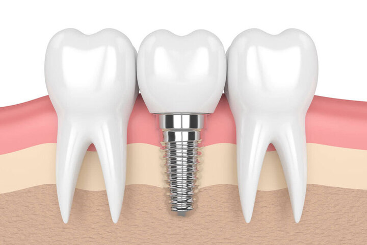 Chăm sóc răng sau khi cấy Implant