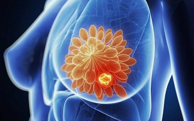 U vú là gì và loại u khác nhau