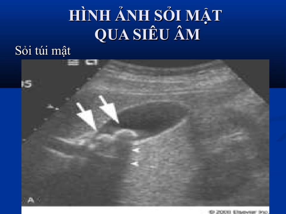 chẩn đoán sỏi túi mật