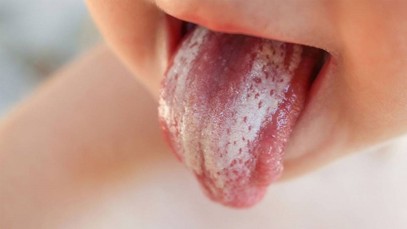 Trào ngược dạ dày có thể gây ra nhiều triệu chứng ở hệ tiêu hóa và khoang miệng
