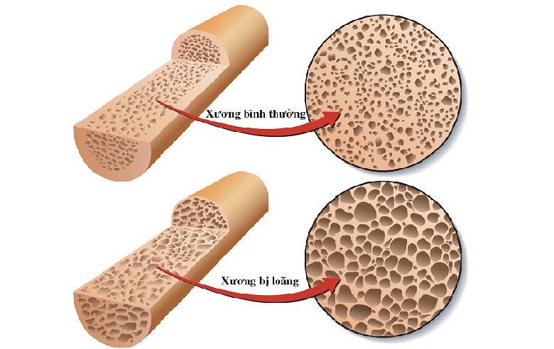 Chẩn đoán loãng xương bằng phương pháp đo mật độ xương