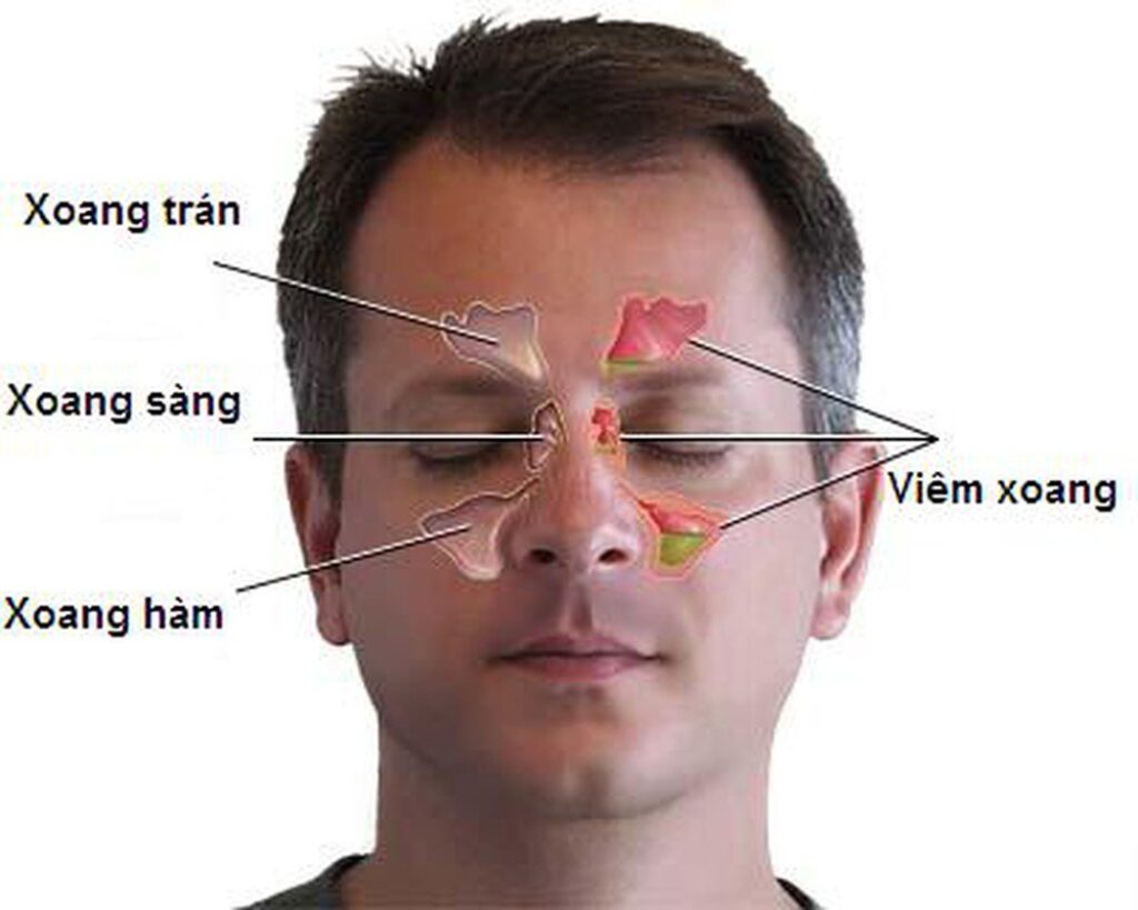 Viêm xoang trán là tình trạng viêm nhiễm ở các xoang nằm trong vùng trán