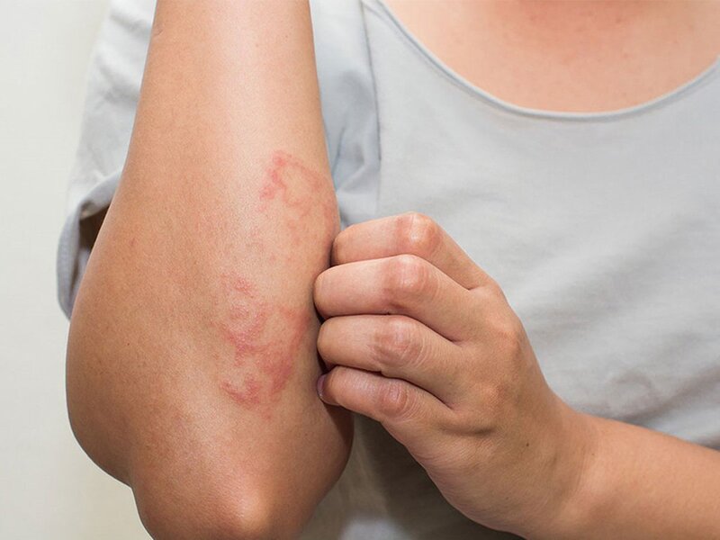 Nguyên nhân gây nên bệnh chốc lở