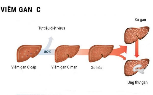 Bệnh viêm gan C tiến triển nặng nếu không kịp thời chữa trị
