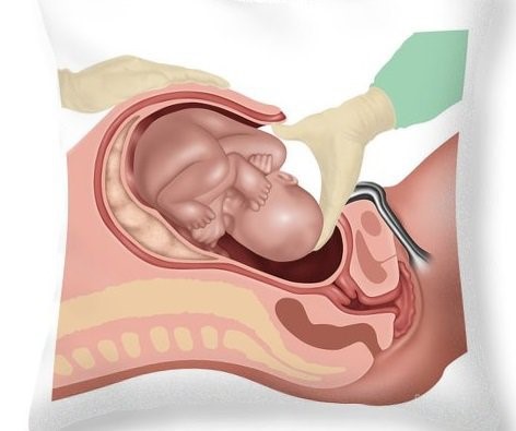 Bác sĩ có thể chỉ định mổ lấy thai