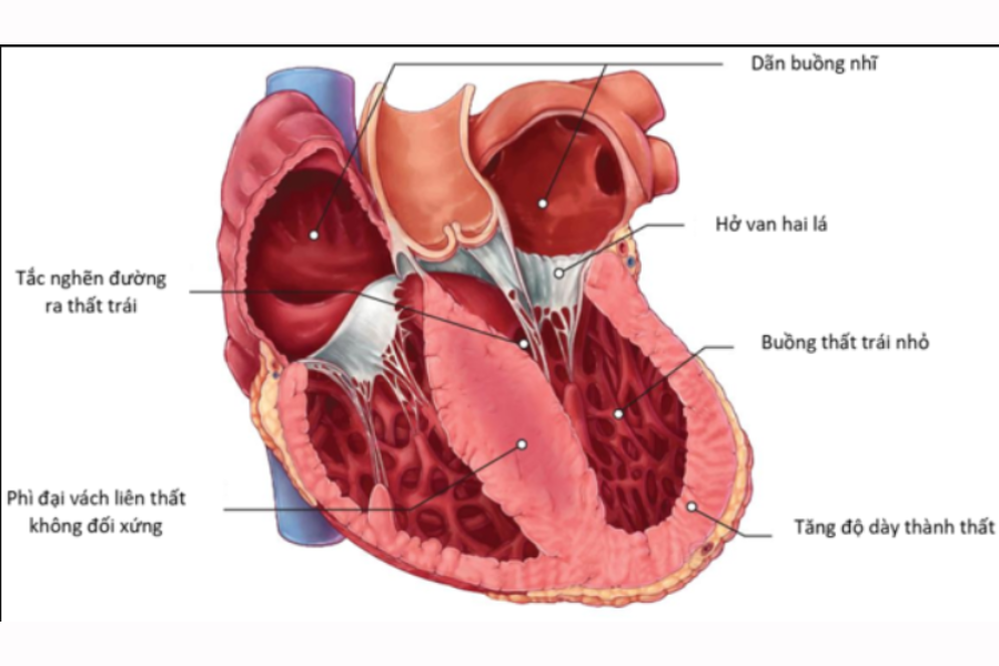 Suy tim do bệnh cơ tim phì đại