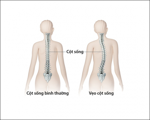 Hình ảnh cho thấy sự khác biệt rõ rệt giữa cột sống bình thường và cột sống bị cong vẹo