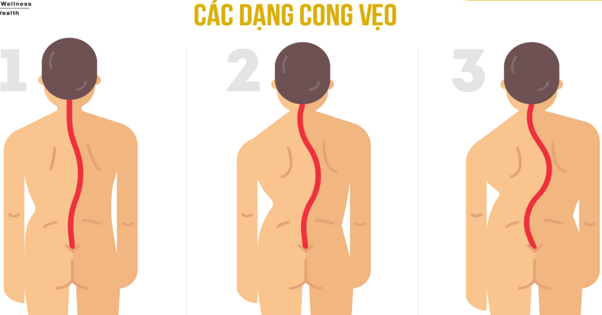 Các dạng cong vẹo cột sống thường gặp