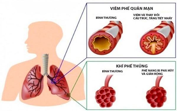 Viêm phế quản mạn tính (biến chứng giãn phế quản)