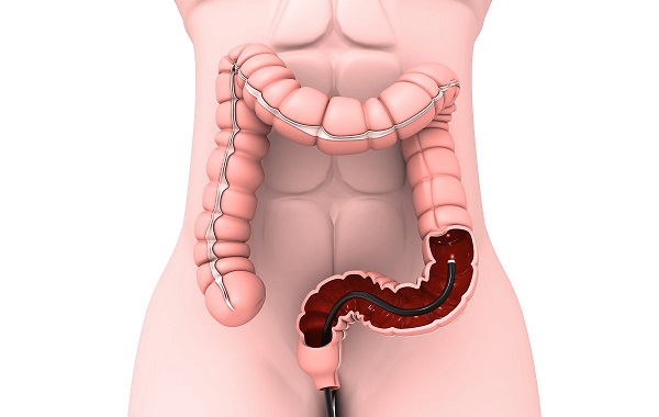 Nội soi đường tiêu hóa dưới trong chẩn đoán bệnh Crohn