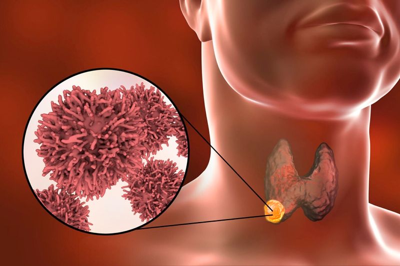 Những điều cần biết về bệnh ung thư tuyến gi&aacute;p: nguy&ecirc;n nh&acirc;n, triệu chứng v&agrave;  phương